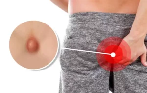 Pilonidal-Sinus Pilonidal-Sinus